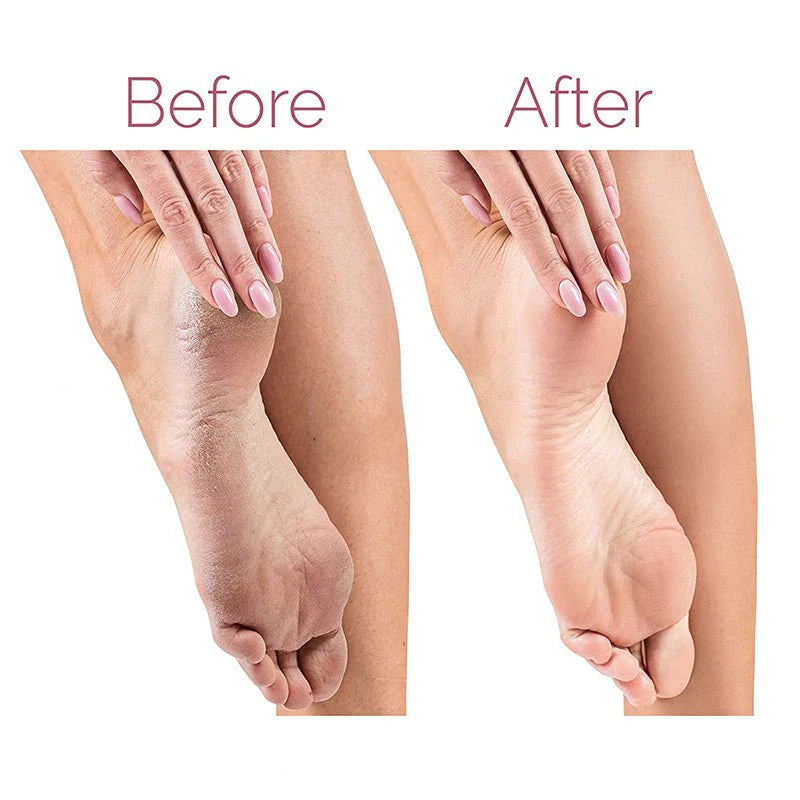 Electric Pedicure Foot File Callus Remover - Lees Store